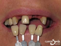Dental Implant – Before – Without dentures