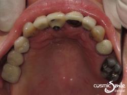 Dental Implant – Top view with implants in place
