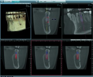 CT screenshot of teeth with implant position overlay