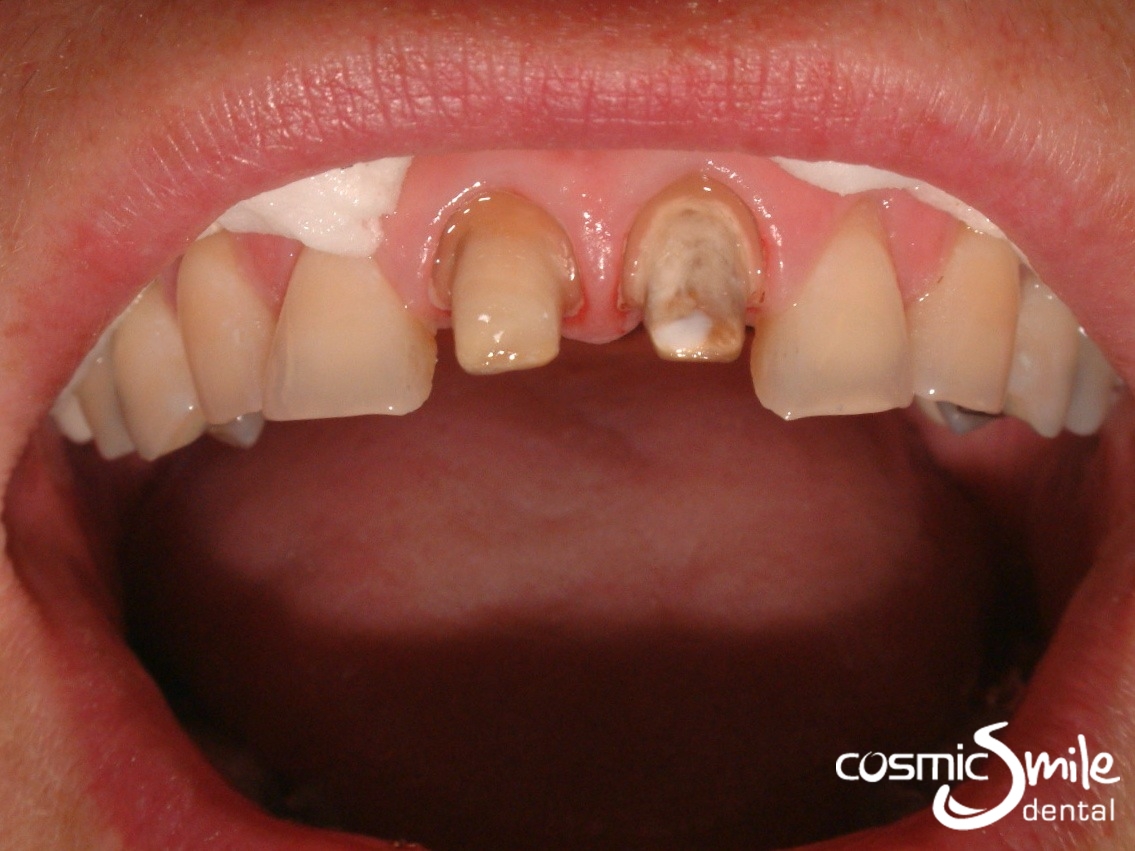 Crowns and Veneers - Before and After - Cosmic Smile ...