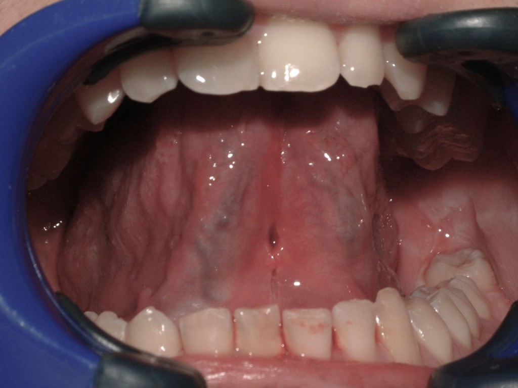 Frenectomy Before and After Cosmic Smile Laser Dental