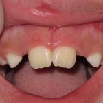 Frenum (one month after frenectomy)