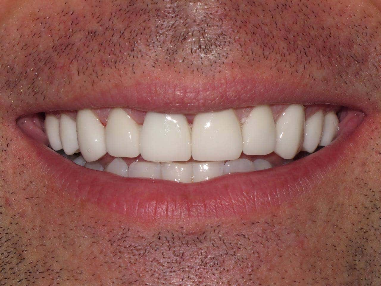 porcelain veneers in Sydney