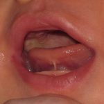 Anterior tongue tie in baby (before laser therapy)