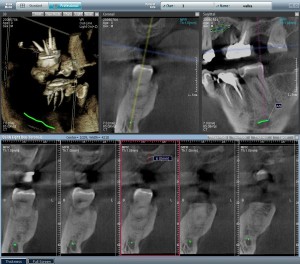 CT   screenshot showing the teeth in 3D with the location of the  Inferior   Alveolar Nerve drawn in