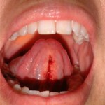 Lingual frenum after laser frenectomy (tongue tie therapy) 