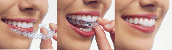 invisalign in Sydney