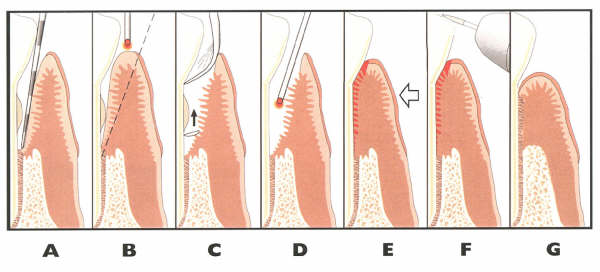 laser periodontal therapy steps