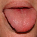 Tongue after laser frenectomy (tongue tie therapy) 