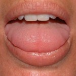 Tongue before treatment 