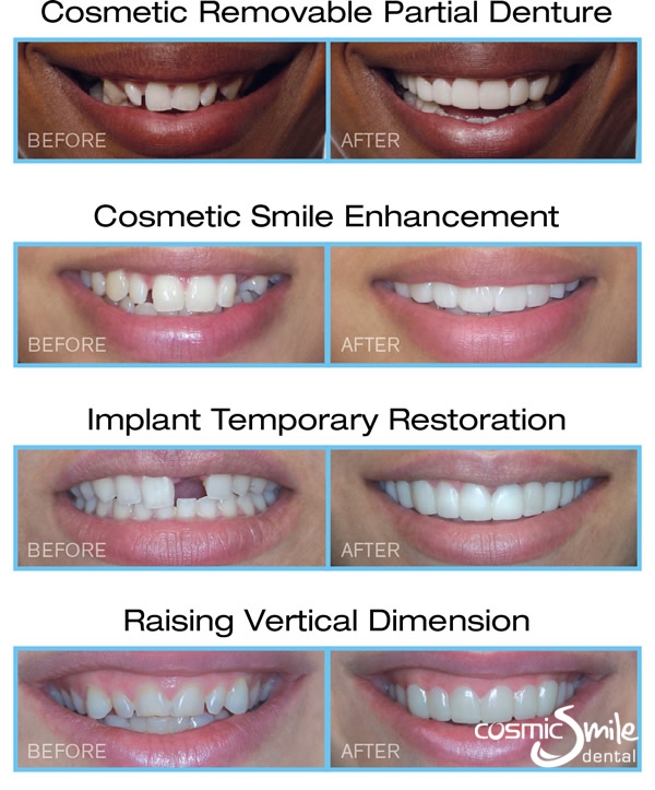 snap on smile cost