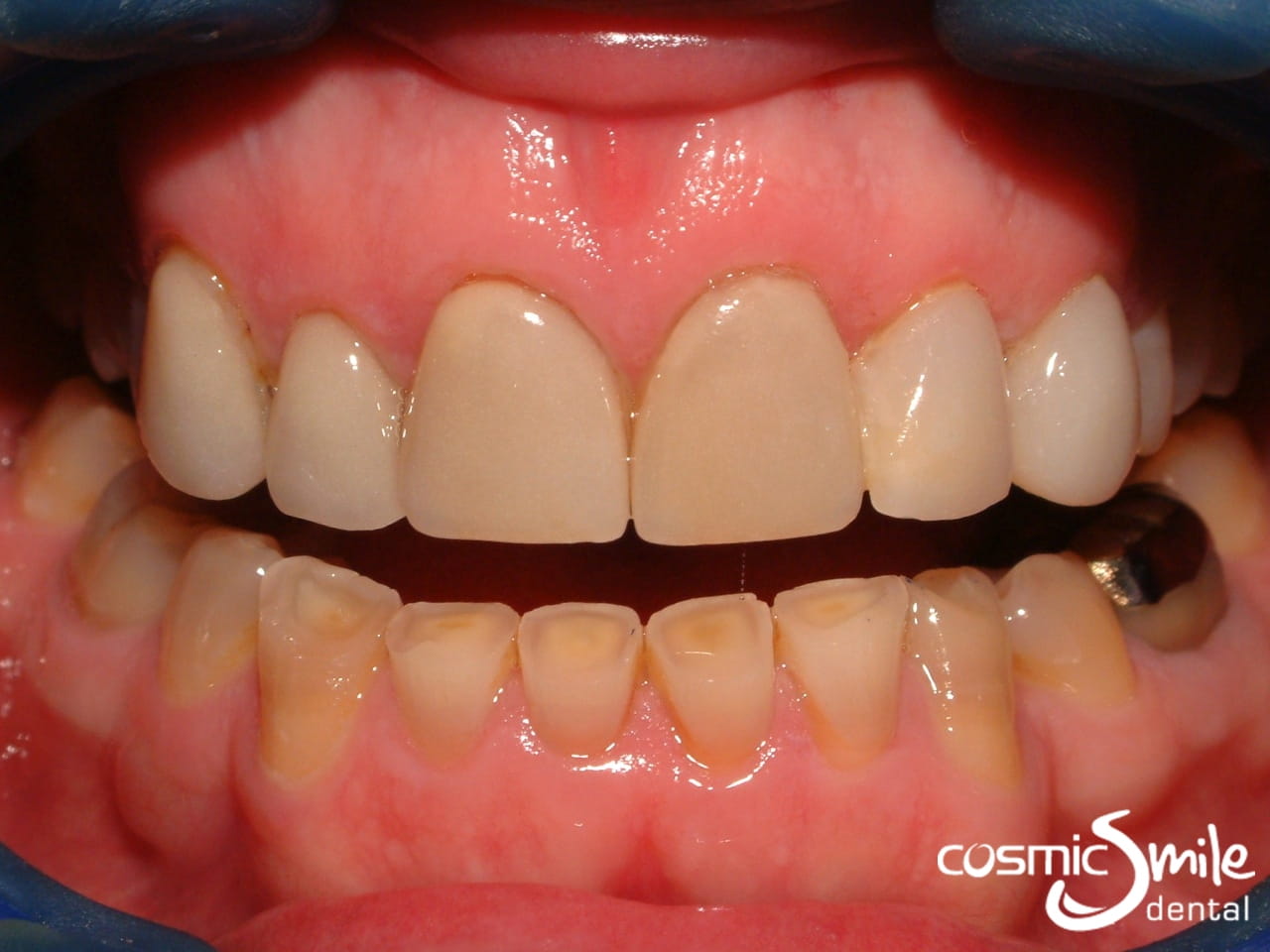 New LUMINEERS on left lateral incisor and canine