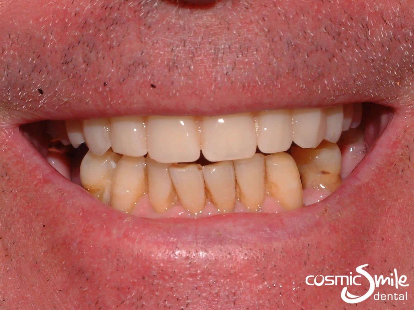 Upper denture retained by mini implants