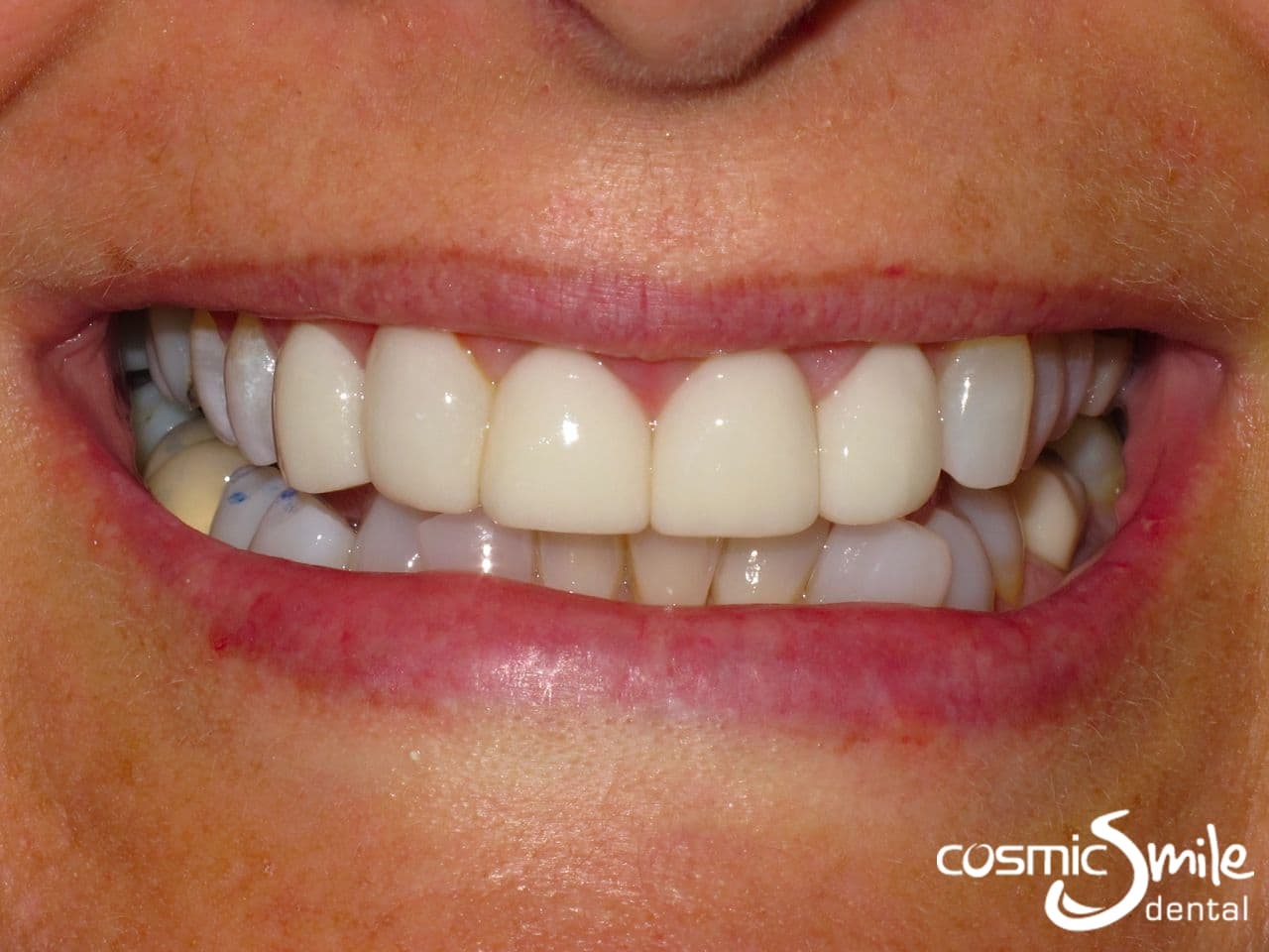 Lumineers – Misaligned front teeth