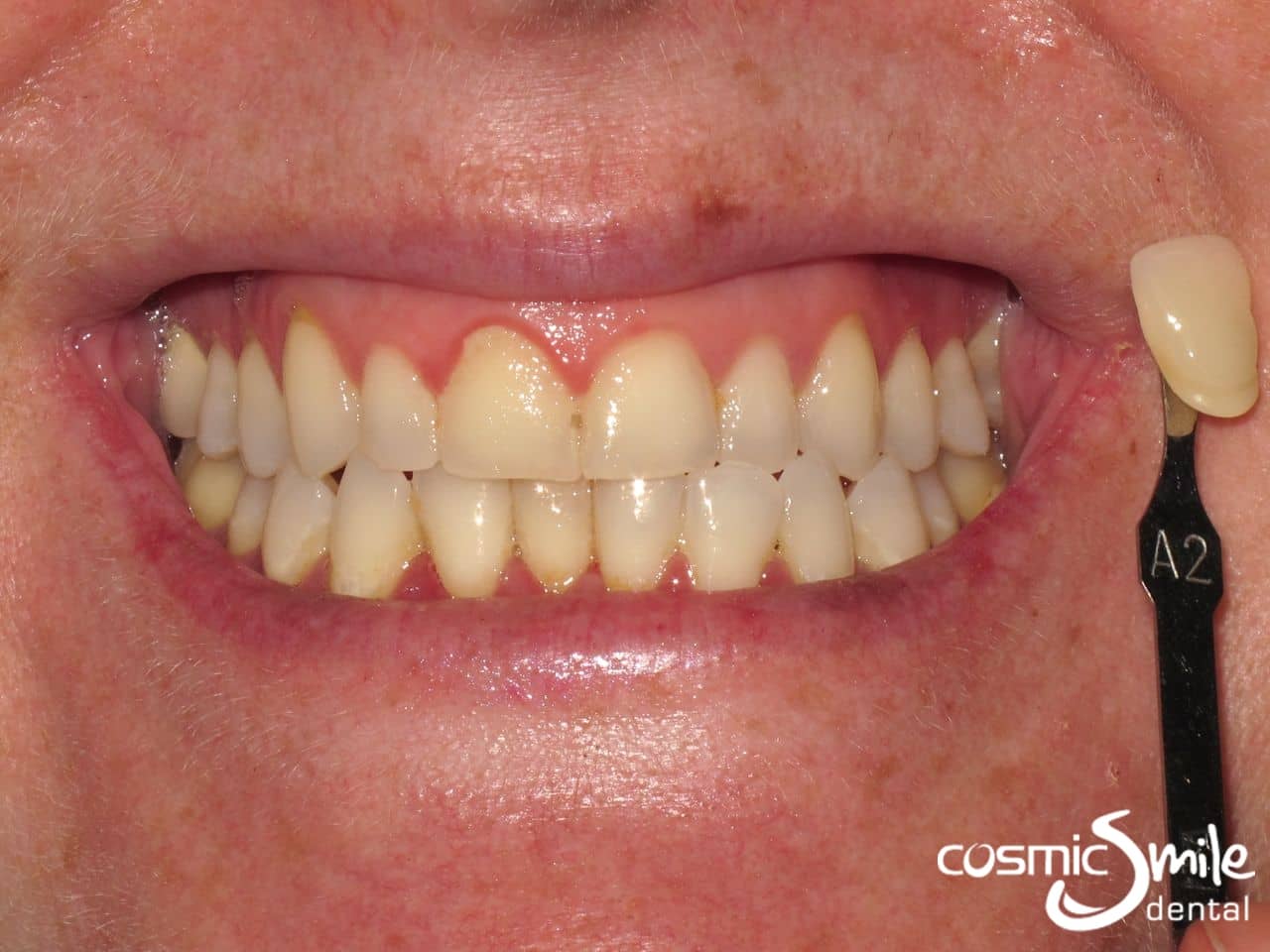 Best Teeth Whitening Sydney - Before and After - Cosmic Smile Dental