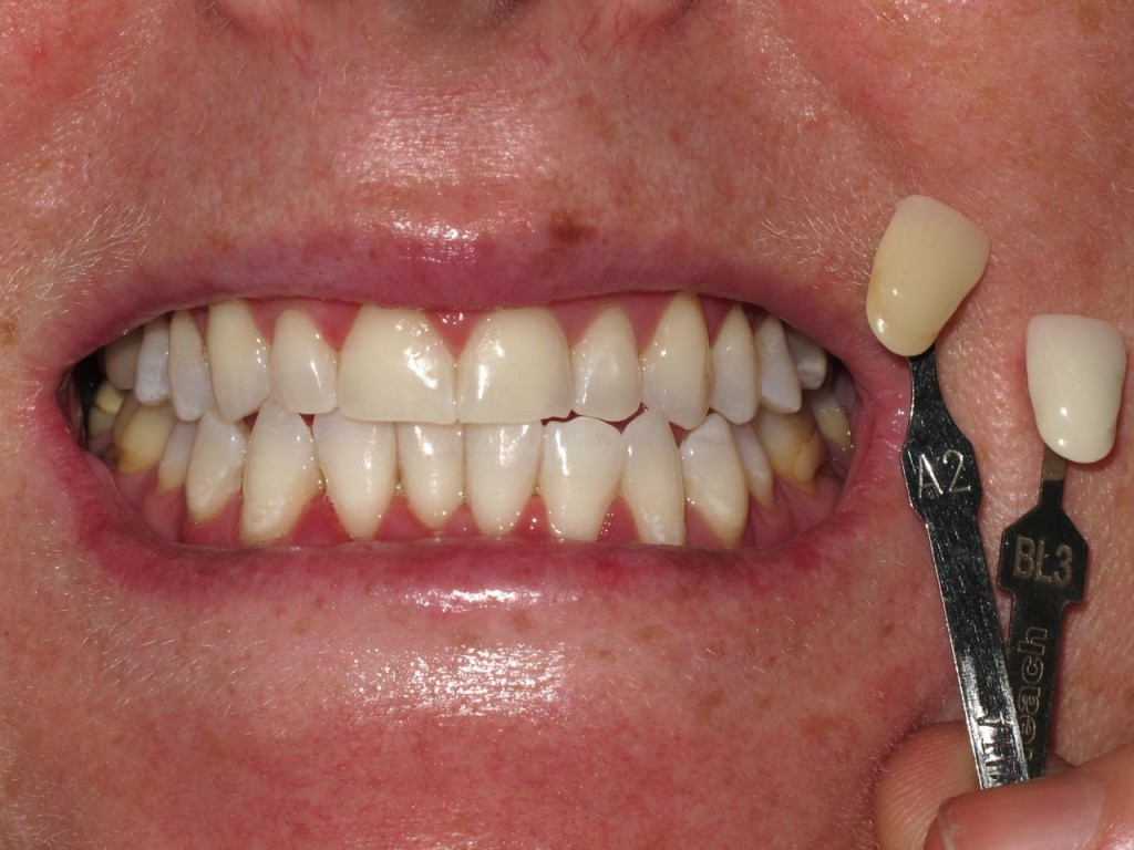 Best Teeth Whitening Sydney Before and After Cosmic Smile Dental