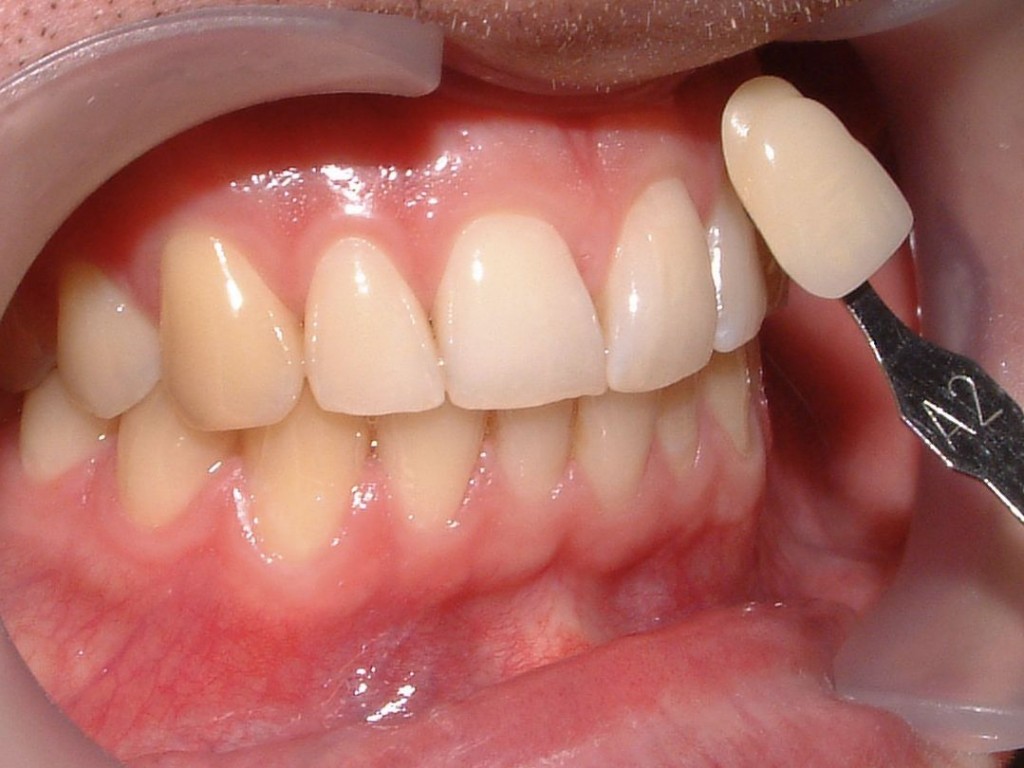 Best Teeth Whitening Sydney Before and After Cosmic Smile Dental