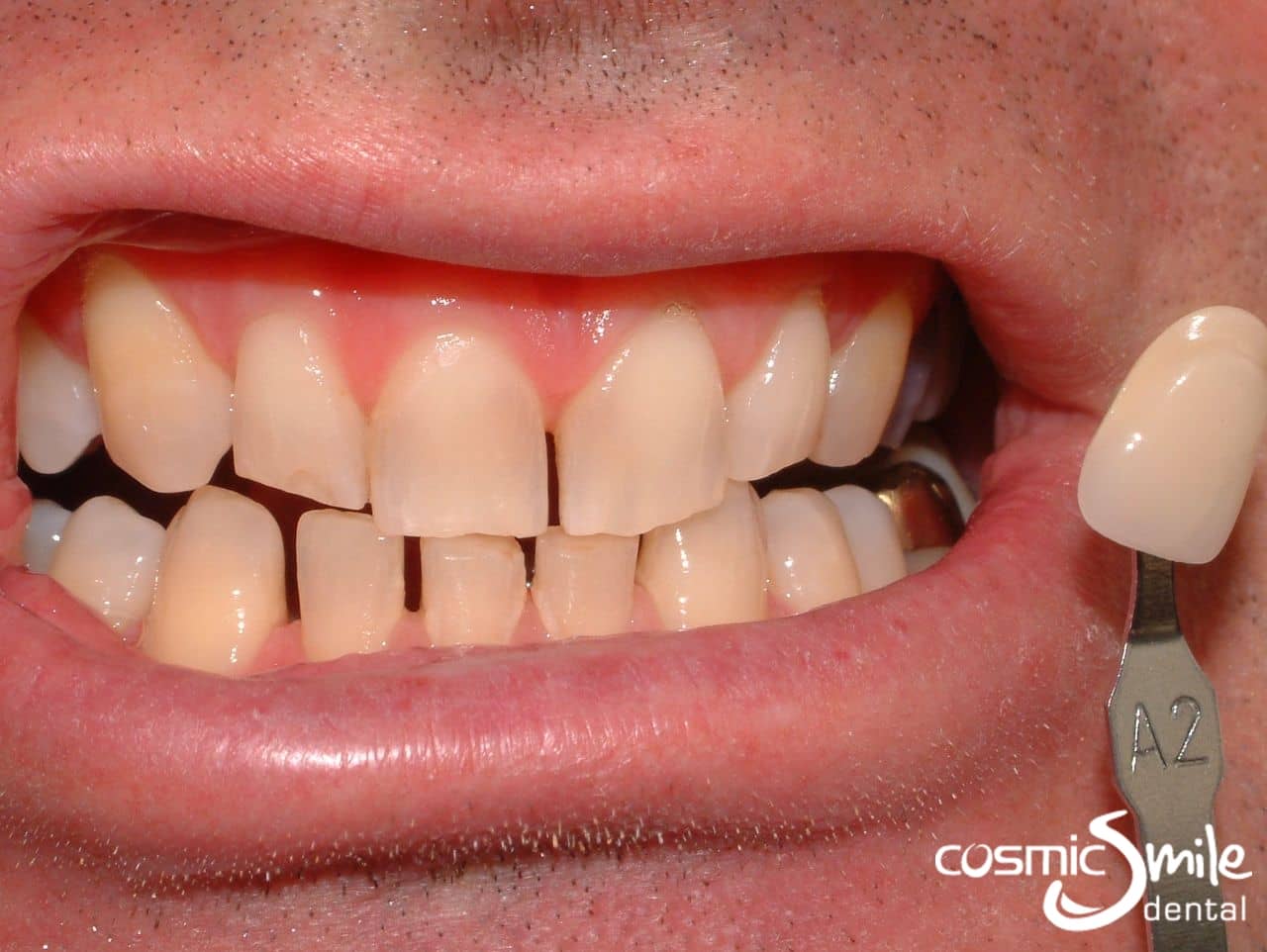 before ZOOM teeth whitening shade A2