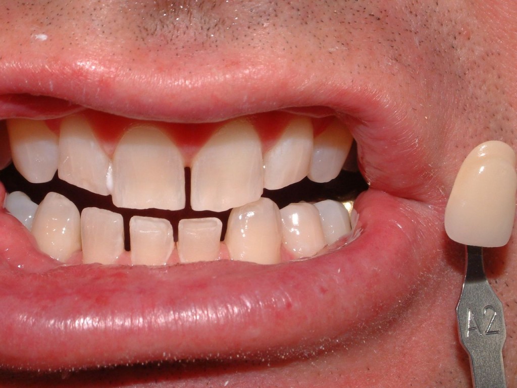 Best Teeth Whitening Sydney Before and After Cosmic Smile Dental