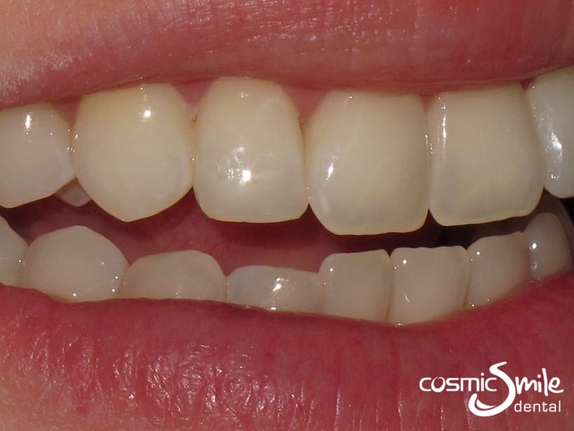 Composite resin modifications on teeth