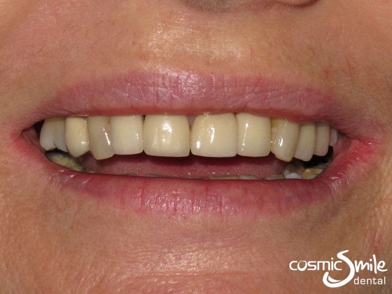 Smile with dental implants in place