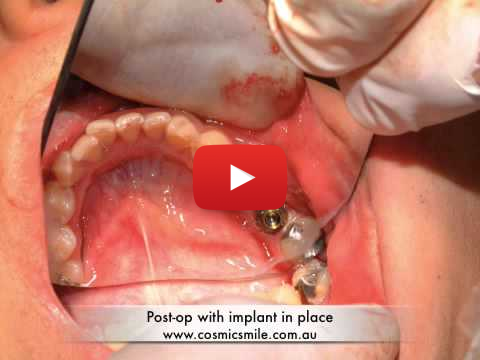 Dental implants video