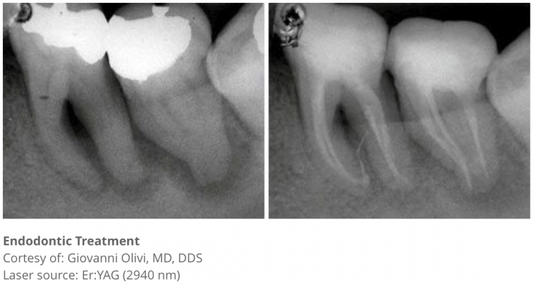 Single-visit Laser Endodontic Treatment with PIPS