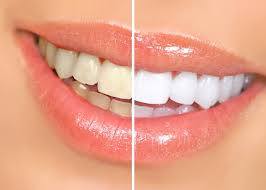 Before and After Teeth Whitening treatment