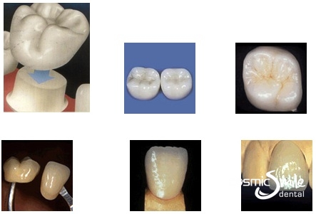 dental crown procedure 