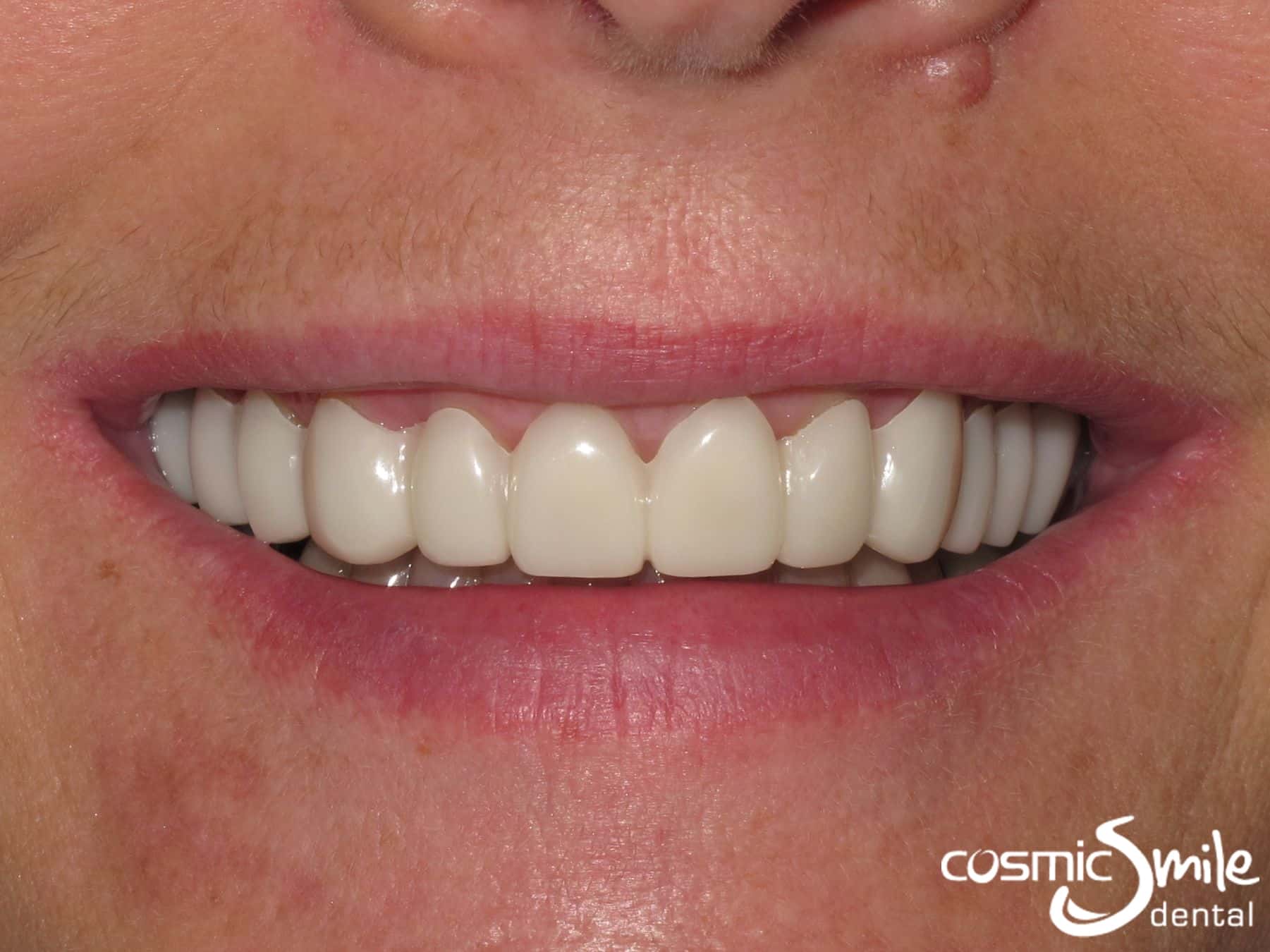 Temporary Veneers Snap on Smile in place