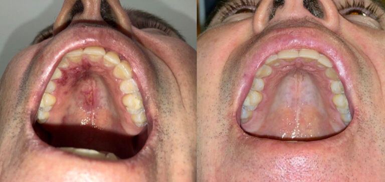 PBM for dental issues image 2