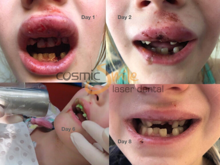 PBM for dental issues in kids