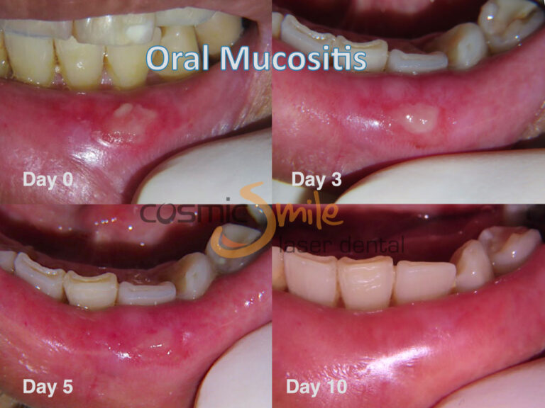 PBM for Oral Mucositis