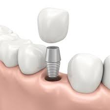 dental implant in Sydney