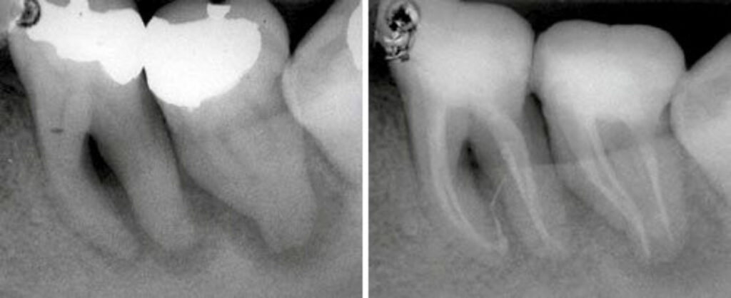 Teeth that need Laser root canal treatments (RCT)