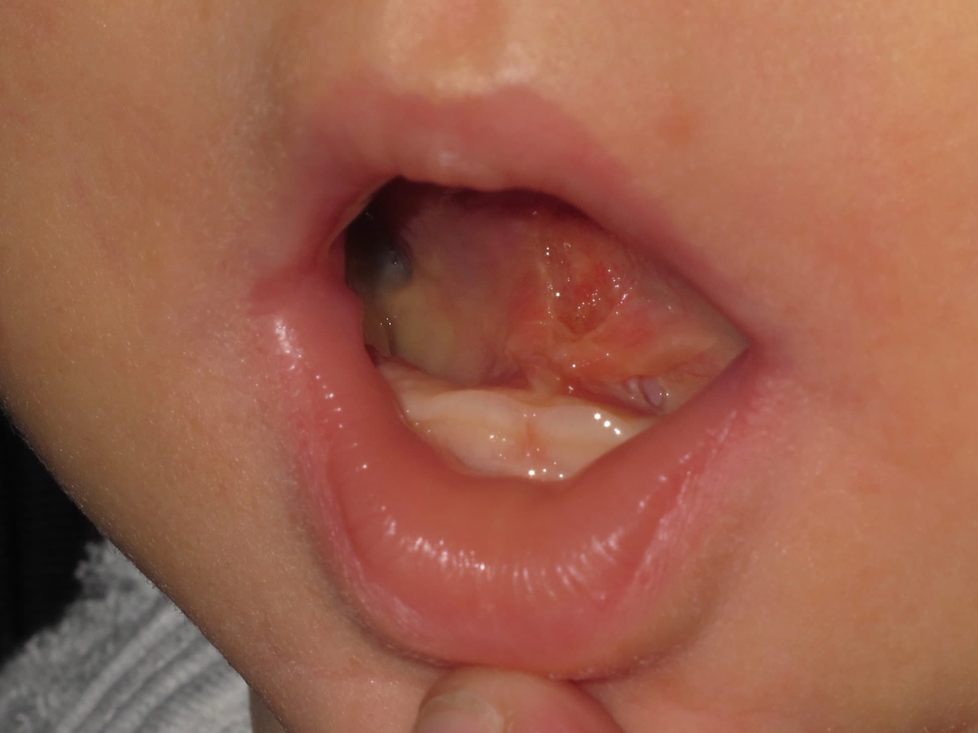 Anterior Tongue Tie in Baby after laser therapy