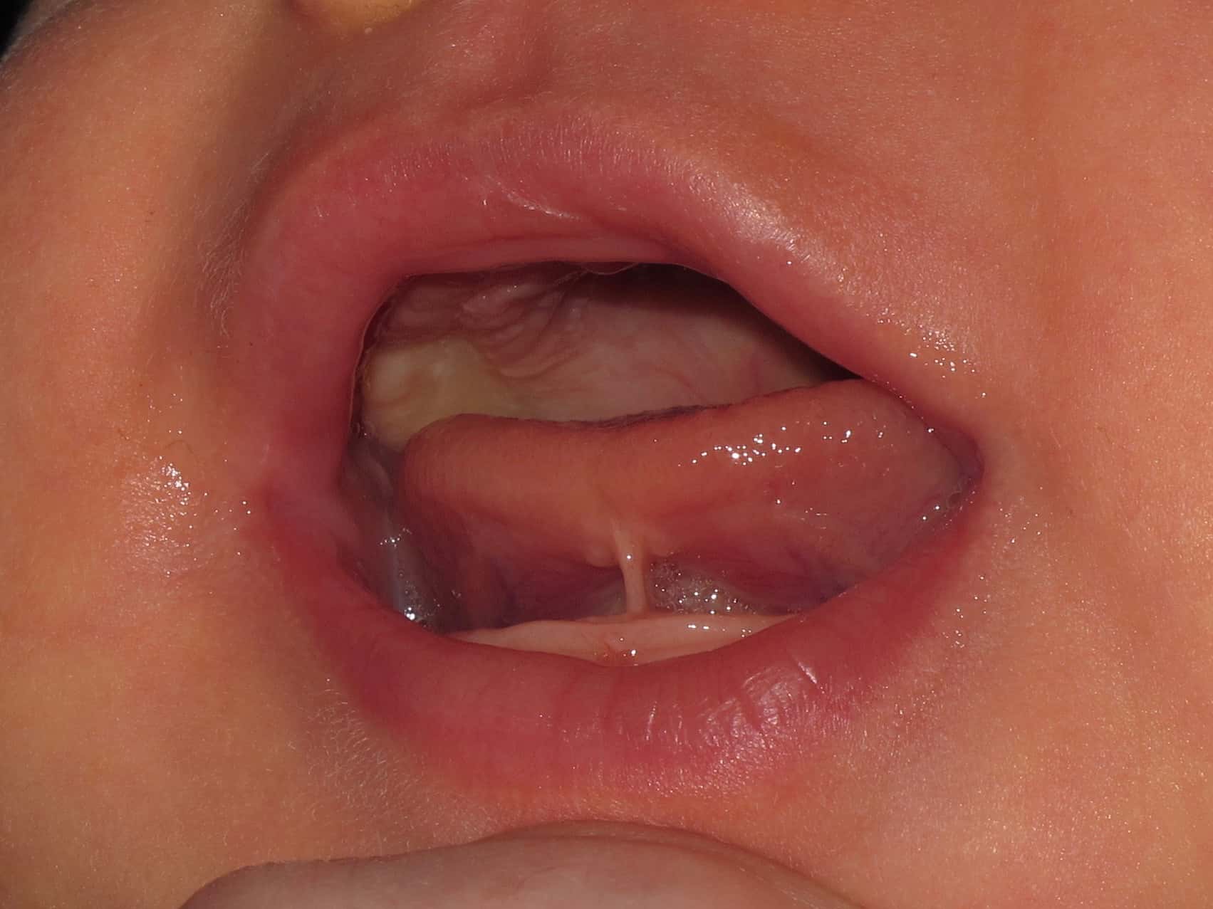 Anterior Tongue Tie in Baby