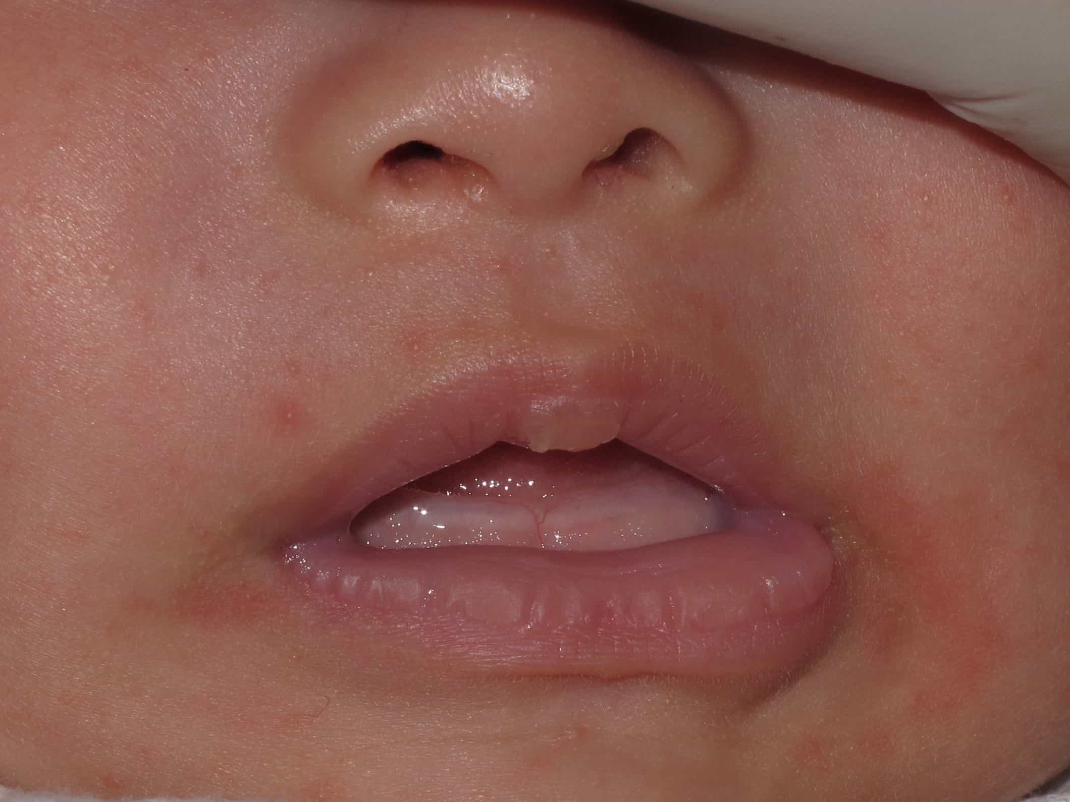 Upper Lip Blister in Baby Due to Upper Lip Tie
