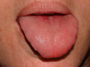 tongue after laser endodontic treatment