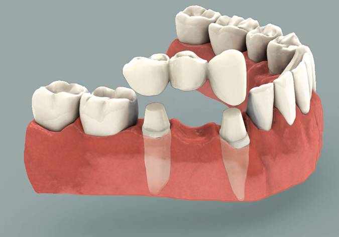 dental bridge from Cosmic Smile Dental