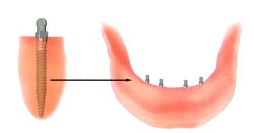 Dental Mini-Implants 1