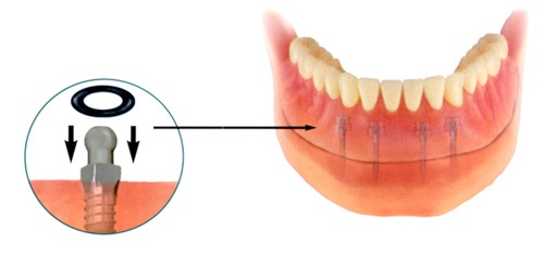 Dental Mini-Implants 2
