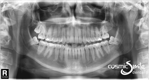 Panoramic x-ray (OPG) of a healthy young jaw