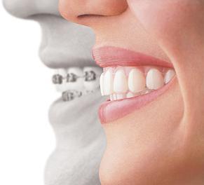 Correcting an overbite - Morley Orthodontic Clinic