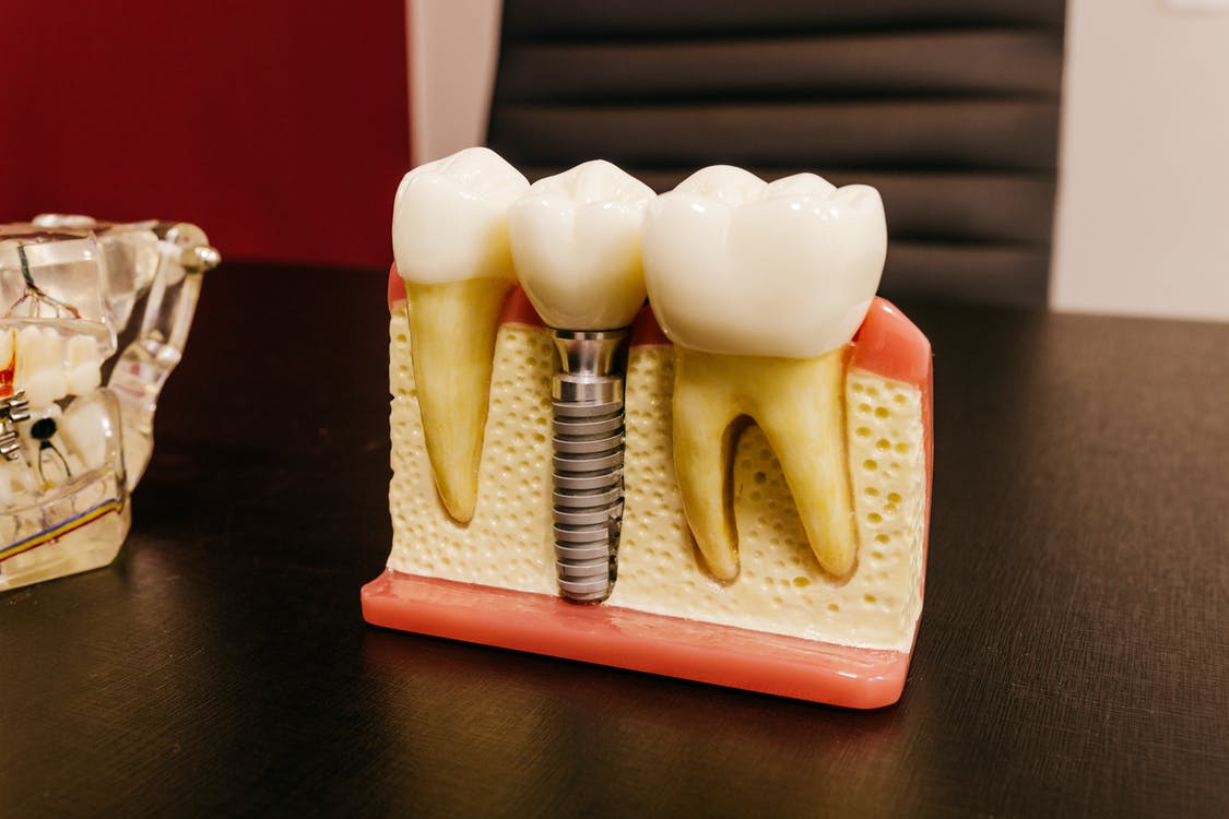 permanent dental implants in Sydney