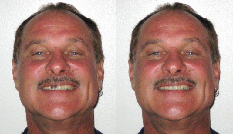 before and after Laser gum disease treatment