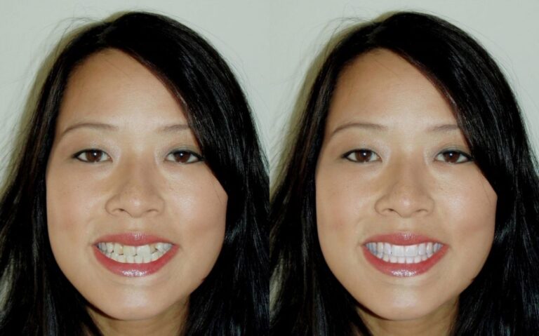 before and after Laser gum disease treatment 2