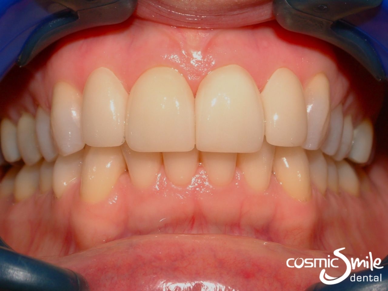 Rectangular LUMINEERS on incisors