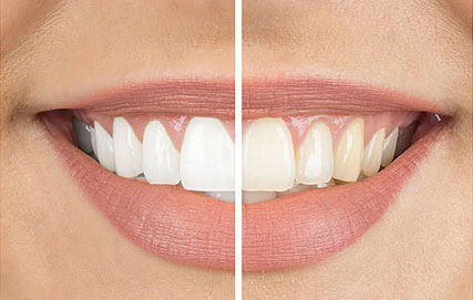 Teeth after ClearCorrect