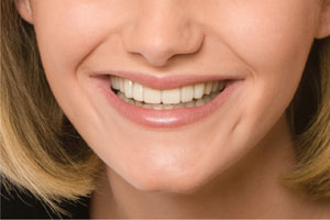 after Snap-On Smile to enhance smile